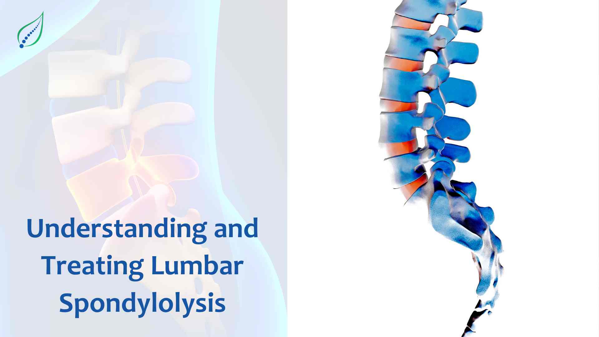 Understanding and Treating Lumbar Spondylolysis